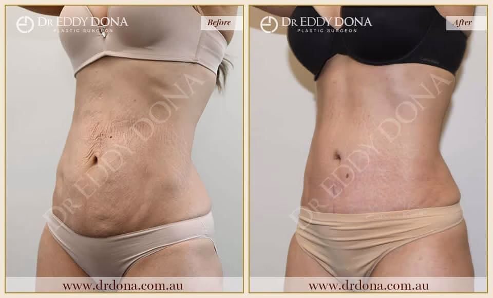 Dr Eddy Dona - Tummy Tuck - Before and After