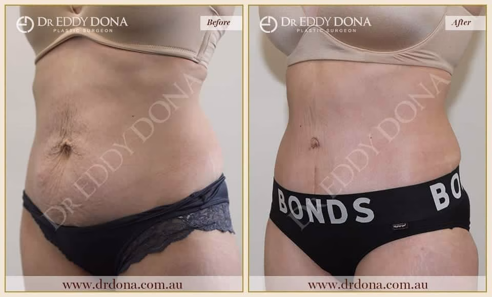 Dr Eddy Dona - Tummy Tuck - Before and After