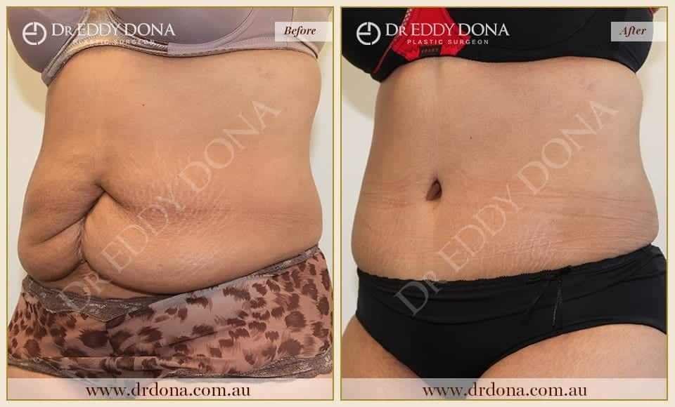 Tummy Tuck Surgery (Abdominoplasty) - Sydney Cosmetic Clinic