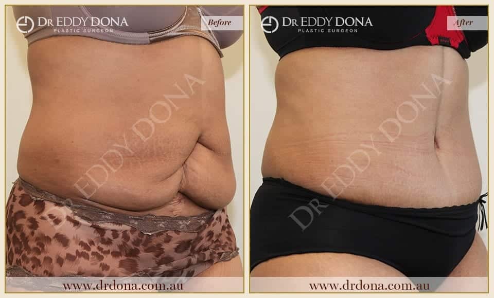 Tummy Tuck Surgery Before And After Gallery Dr Eddy Dona Tummy Tuck Surgery Before And After Gallery Dr Eddy Dona