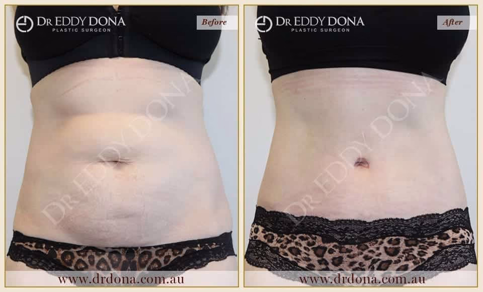 Dr Eddy Dona Plastic Surgery Tummy Tuck Before and After Frontal