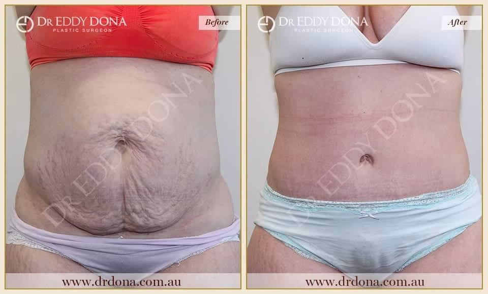 Dr Eddy Dona Plastic Surgery Tummy Tuck Before and After Frontal