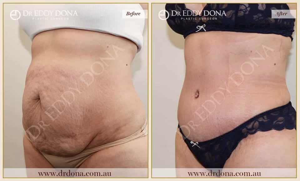 Dr Eddy Dona Plastic Surgery Tummy Tuck Before and After Left Oblique