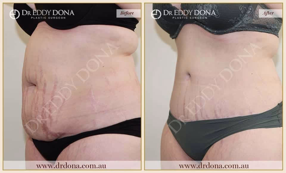 Dr Eddy Dona - Tummy Tuck Surgery - O8513 L-min