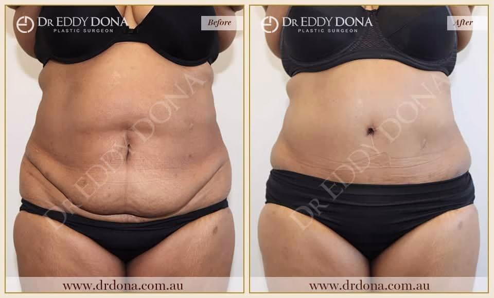 Dr Eddy Dona - Tummy Tuck - Before and After