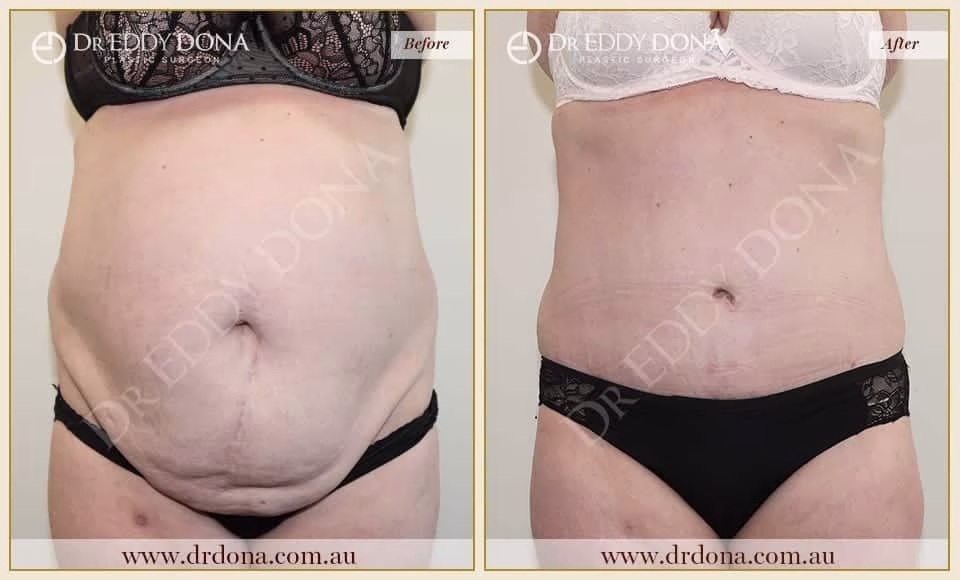 Dr Eddy Dona - Tummy Tuck - Before and After