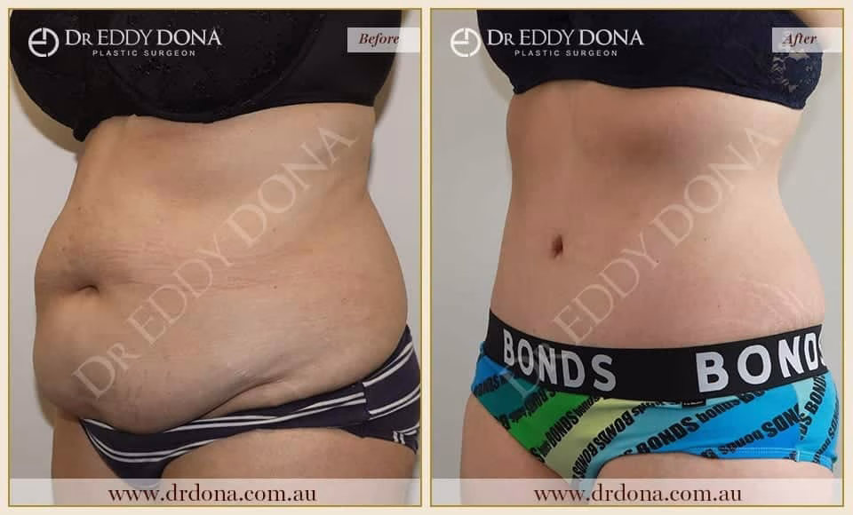 Dr Eddy Dona Tummy Tuck Before and After