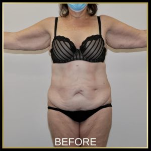 Open Book Tummy Tuck™ (Abdominoplasty) 11c O11535