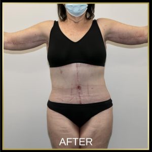 Open Book Tummy Tuck™ (Abdominoplasty) 11dO11535