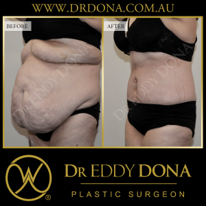 Open Book Tummy Tuck™ (Abdominoplasty) 13b O12082