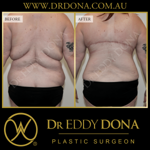 Open Book Tummy Tuck™ (Abdominoplasty) 13c O12082