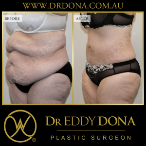 Open Book Tummy Tuck™ (Abdominoplasty) 16b O11738