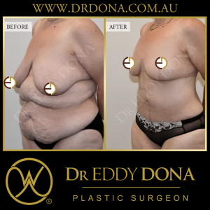 Open Book Tummy Tuck™ (Abdominoplasty) 16d O11738