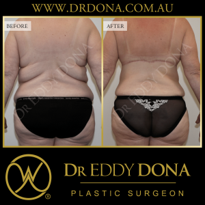 Open Book Tummy Tuck™ (Abdominoplasty) 16e O11738