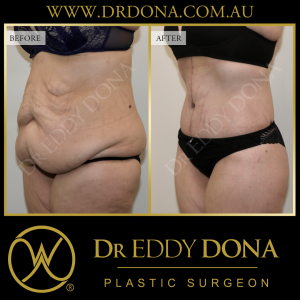 Open Book Tummy Tuck™ (Abdominoplasty) 17b O12156