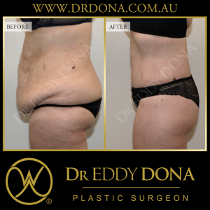 Open Book Tummy Tuck™ (Abdominoplasty) 17c O12156