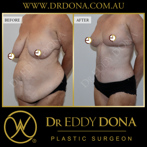 Open Book Tummy Tuck™ (Abdominoplasty) 26d O12194