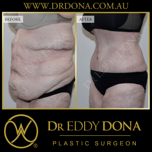 Open Book Tummy Tuck™ (Abdominoplasty) 31b O12752