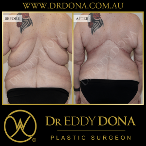 Open Book Tummy Tuck™ (Abdominoplasty) 31c O12752