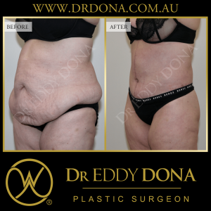 Open Book Tummy Tuck™ (Abdominoplasty) 34bb O12314