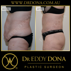 Open Book Tummy Tuck™ (Abdominoplasty) 34c O12314