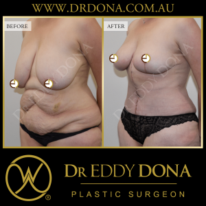 Open Book Tummy Tuck™ (Abdominoplasty) 3d O11238