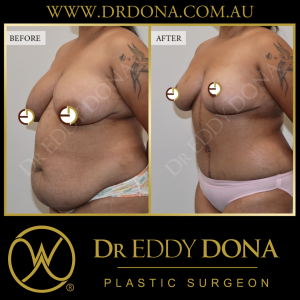 Open Book Tummy Tuck™ (Abdominoplasty) 5c O10045