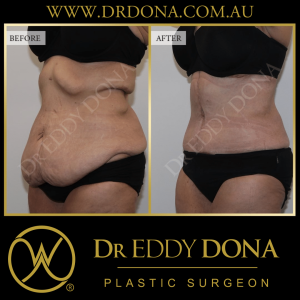 Open Book Tummy Tuck™ (Abdominoplasty) 9b O11122