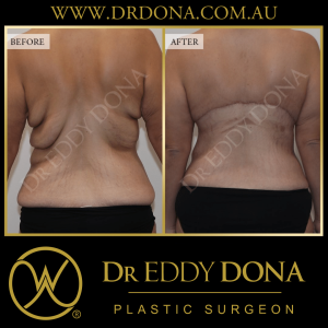 Open Book Tummy Tuck™ (Abdominoplasty) 9c O11122