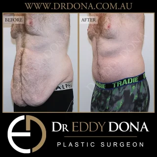 Fleur De Lis TUMMY TUCK (Abdominoplasty)
& BODY LIFT  This patient had lost over 80kg and required a total body reconstruction. Dr Dona performed a Fleur De Lis Abdominoplasty with a Body Lift, removing over 5kg of excess skin and fatty tissue. 
Experience & Excellence in Plastic Surgery is what you deserve  #DrEddyDona #FleurDeLis #OpenBook #TummyTuck #Abdominoplasty #PlasticSurgery  DISCLAIMER: All surgeries on this page are performed by Dr Eddy Dona, and are published with the written consent by the patients. Before & after images are generally shown between 3-6 months post-surgery. 
All surgery carries risks, requires recovery time, and the results will vary for each individual patient. The content on this page is general in nature and is not a substitute for a formal consultation. 
Before proceeding please seek medical advice from an appropriately qualified medical practitioner. 
To learn more visit our website and/or YouTube channel - links can be found in our bio.
Dr Eddy Dona is a Specialist Plastic Surgeon 
(Registration: MED0001177175)