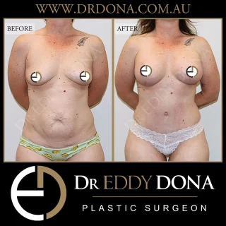 Tummy Tuck (Abdominoplasty) & Breast Augmentation  Experience & Excellence in Plastic Surgery is what you deserve.  #DrEddyDona #PlasticSurgeon #PlasticSurgery #TummyTuck #BreastAugmentation  All surgery carries risks. You can learn more by visiting our website - link can be found in our bio.
Or go to www.drdonaplasticsurgery.com.au/surgery-risks/
.
DISCLAIMER: All surgeries on this page are performed by Dr Eddy Dona and are published with the written consent by the patients. Before & after images are generally shown between 3-6 months post-surgery.
All surgery requires recovery time.
The outcomes shown are only relevant for this patient and do not necessarily reflect the results other patients may experience, even if they have a similar body type or shape. Results may vary due to many factors including an individual’s genetics and lifestyle.
The content on this page is general in nature and is not a substitute for a formal consultation.
Before proceeding, please seek medical advice from an appropriately qualified medical practitioner.
Dr Eddy Dona is a Specialist Plastic Surgeon
(Registration: MED0001177175)