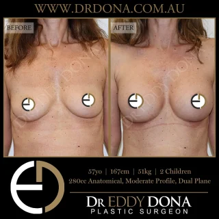 BIO Lift ™: Breast Implant Only Lift  Experience & Excellence in Plastic Surgery is what you deserve.  #BreastImplants #DrEddyDona #PlasticSurgery #BreastAugmentation  All surgery carries risks. You can learn more by visiting our website - link can be found in our
bio.
Or go to http://www.drdonaplasticsurgery.com.au/surgery-risks/  DISCLAIMER: All surgeries on this page are performed by Dr Eddy Dona and are published with the written consent by the patients.
After images are generally taken between 3-6 months post-surgery.
All surgery requires recovery time.
The outcomes shown are only relevant for this patient and do not necessarily reflect the results other patients may experience, even if they have a similar body type or shape.
Results may vary due to many factors including an individual’s genetics and lifestyle.
The content on this page is general in nature and is not a substitute for a formal consultation.
Before proceeding, please seek medical advice from an appropriately qualified medical practitioner.
Dr Eddy Dona is a Specialist Plastic Surgeon
(Registration: MED0001177175)