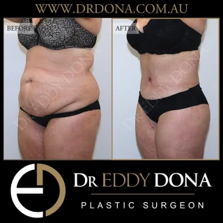 BELT LIPECTOMY  The Belt Lipectomy is an operation that goes by many different names:  - 360 Tummy Tuck (Abdominoplasty)
- Lower Body Lift 
- Total Body Lift
- Lower Truncoplasty 
- Buttock Lift combined with a Tummy Tuck  Experience & Excellence in Plastic Surgery is what you deserve  #DrEddyDona  #PlasticSurgeon #BraLipectomy  #FleurDeLis #OpenBook  #TummyTuck#Abdominoplasty #BeltLipectomy  All surgery carries risks. You can learn more by visiting our website - link can be found in our bio. Or go to www.drdonaplasticsurgery.com.au/surgery-risks/ 
DISCLAIMER: All surgeries on this page are performed by Dr Eddy Dona and are published with the written consent by the patients.
After images are generally taken between 3-6 months post-surgery.
All surgery requires recovery time.
The outcomes shown are only relevant for this patient and do not necessarily reflect the results other patients may experience, even if they have a similar body type or shape. Results may vary due to many factors including an individual’s genetics and lifestyle.
The content on this page is general in nature and is not a substitute for a formal consultation. Before proceeding, please seek medical advice from an appropriately qualified medical practitioner. Dr Eddy Dona is a Specialist Plastic Surgeon (Registration: MED0001177175)