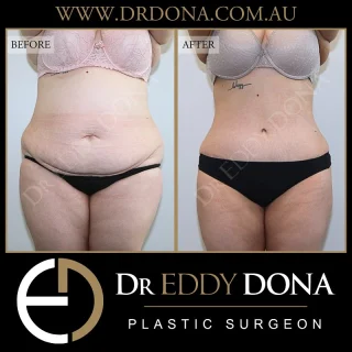 Two staged procedures - ABDOMINOPLASTY, followed by a BUTTOCK LIFT  Experience & Excellence in Plastic Surgery is what you deserve  #DrEddyDona  #PlasticSurgeon #BraLipectomy  #FleurDeLis #OpenBook  #TummyTuck#Abdominoplasty #BeltLipectomy  All surgery carries risks. You can learn more by visiting our website - link can be found in our bio. Or go to www.drdonaplasticsurgery.com.au/surgery-risks/ 
DISCLAIMER: All surgeries on this page are performed by Dr Eddy Dona and are published with the written consent by the patients.
After images are generally taken between 3-6 months post-surgery.
All surgery requires recovery time.
The outcomes shown are only relevant for this patient and do not necessarily reflect the results other patients may experience, even if they have a similar body type or shape. Results may vary due to many factors including an individual’s genetics and lifestyle.
The content on this page is general in nature and is not a substitute for a formal consultation. Before proceeding, please seek medical advice from an appropriately qualified medical practitioner. Dr Eddy Dona is a Specialist Plastic Surgeon (Registration: MED0001177175)