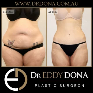WEIGHT LOSS AFTER ABDOMINOPLASTY SURGERY  Dr Dona performed an abdominoplasty on this patient a few years prior. Subsequent to her Tummy Tuck, she lost a significant amount of weight. She now presents to our clinic to address excess skin concerns she has in other parts of the body. You’ll note that her abdominal wall remains tight and toned, and she not developed any further excess skin concerns.  One excuse used by surgeons to deny fuller figured patients abdominoplasty surgery is that they will need abdominoplasty surgery again if they lose weight. This has NOT been true for any of the patients that Dr Dona has treated.  Experience & Excellence in Plastic Surgery is what you deserve  #DrEddyDona #TummyTuck #Abdominoplasty  DISCLAIMER: All surgeries on this page are performed by Dr Eddy Dona, and are published with the written consent by the patients. Before & after images are generally shown between 3-6 months post-surgery. 
All surgery carries risks, requires recovery time, and the results will vary for each individual patient. The content on this page is general in nature and is not a substitute for a formal consultation. 
Before proceeding please seek medical advice from an appropriately qualified medical practitioner. 
To learn more visit our website and/or YouTube channel - links can be found in our bio.
Dr Eddy Dona is a Specialist Plastic Surgeon 
(Registration: MED0001177175)