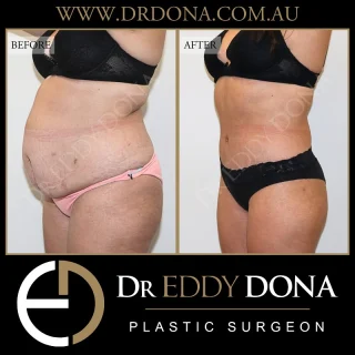 360 Tummy Tuck (Belt Lipectomy)  Experience & Excellence in Plastic Surgery is what you deserve  #DrEddyDona  #PlasticSurgeon #BraLipectomy  #FleurDeLis #OpenBook  #TummyTuck#Abdominoplasty #BeltLipectomy  All surgery carries risks. You can learn more by visiting our website - link can be found in our bio. Or go to www.drdonaplasticsurgery.com.au/surgery-risks/ 
DISCLAIMER: All surgeries on this page are performed by Dr Eddy Dona and are published with the written consent by the patients.
After images are generally taken between 3-6 months post-surgery.
All surgery requires recovery time.
The outcomes shown are only relevant for this patient and do not necessarily reflect the results other patients may experience, even if they have a similar body type or shape. Results may vary due to many factors including an individual’s genetics and lifestyle.
The content on this page is general in nature and is not a substitute for a formal consultation. Before proceeding, please seek medical advice from an appropriately qualified medical practitioner. Dr Eddy Dona is a Specialist Plastic Surgeon (Registration: MED0001177175)