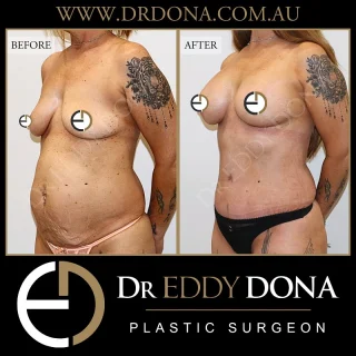 BIO Lift ™: Breast Implant Only Lift + Abdominoplasty  Experience & Excellence in Plastic Surgery is what you deserve.  #BreastImplants #DrEddyDona #PlasticSurgery #BreastAugmentation #Abdominoplasty  All surgery carries risks. You can learn more by visiting our website - link can be found in our
bio.
Or go to http://www.drdonaplasticsurgery.com.au/surgery-risks/  DISCLAIMER: All surgeries on this page are performed by Dr Eddy Dona and are published with the written consent by the patients.
After images are generally taken between 3-6 months post-surgery.
All surgery requires recovery time.
The outcomes shown are only relevant for this patient and do not necessarily reflect the results other patients may experience, even if they have a similar body type or shape.
Results may vary due to many factors including an individual’s genetics and lifestyle.
The content on this page is general in nature and is not a substitute for a formal consultation.
Before proceeding, please seek medical advice from an appropriately qualified medical practitioner.
Dr Eddy Dona is a Specialist Plastic Surgeon
(Registration: MED0001177175)