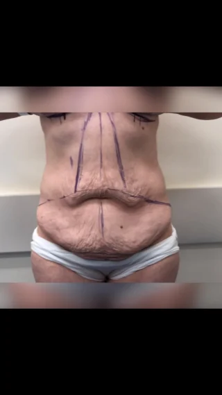 Fleur De Lis TUMMY TUCK (Abdominoplasty)  This patient had lost approximately 70kg and required a total body reconstruction. Dr Dona performed a Fleur De Lis Abdominoplasty. 
Experience & Excellence in Plastic Surgery is what you deserve  #DrEddyDona #FleurDeLis #OpenBook #TummyTuck #Abdominoplasty #PlasticSurgery  DISCLAIMER: All surgeries on this page are performed by Dr Eddy Dona, and are published with the written consent by the patients. Before & after images are generally shown between 3-6 months post-surgery. 
All surgery carries risks, requires recovery time, and the results will vary for each individual patient. The content on this page is general in nature and is not a substitute for a formal consultation. 
Before proceeding please seek medical advice from an appropriately qualified medical practitioner. 
To learn more visit our website and/or YouTube channel - links can be found in our bio.
Dr Eddy Dona is a Specialist Plastic Surgeon 
(Registration: MED0001177175)