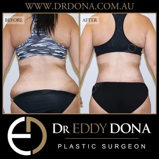 360 Tummy Tuck (Belt Lipectomy)

Experience & Excellence in Plastic Surgery is what you deserve

#DrEddyDona  #PlasticSurgeon #BraLipectomy  #FleurDeLis #OpenBook  #TummyTuck#Abdominoplasty #BeltLipectomy 

All surgery carries risks. You can learn more by visiting our website - link can be found in our bio. Or go to www.drdonaplasticsurgery.com.au/surgery-risks/ 
DISCLAIMER: All surgeries on this page are performed by Dr Eddy Dona and are published with the written consent by the patients.
After images are generally taken between 3-6 months post-surgery.
All surgery requires recovery time.
The outcomes shown are only relevant for this patient and do not necessarily reflect the results other patients may experience, even if they have a similar body type or shape. Results may vary due to many factors including an individual’s genetics and lifestyle.
The content on this page is general in nature and is not a substitute for a formal consultation. Before proceeding, please seek medical advice from an appropriately qualified medical practitioner. Dr Eddy Dona is a Specialist Plastic Surgeon (Registration: MED0001177175)