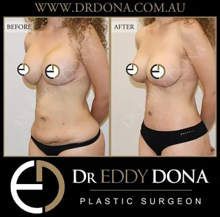 Belt Lipectomy (also known as 360 Tummy Tuck or Total Body Lift) & Breast Implant Exchange 

Experience & Excellence in Plastic Surgery is what you deserve

#DrEddyDona  #PlasticSurgeon #360TummyTuck #TotalBodyLift  #TummyTuck #Abdominoplasty #BreastReduction 

All surgery carries risks. You can learn more by visiting our website - link can be found in our bio. Or go to www.drdonaplasticsurgery.com.au/surgery-risks/ 
DISCLAIMER: All surgeries on this page are performed by Dr Eddy Dona and are published with the written consent by the patients.
After images are generally taken between 3-6 months post-surgery.
All surgery requires recovery time.
The outcomes shown are only relevant for this patient and do not necessarily reflect the results other patients may experience, even if they have a similar body type or shape. Results may vary due to many factors including an individual’s genetics and lifestyle.
The content on this page is general in nature and is not a substitute for a formal consultation. Before proceeding, please seek medical advice from an appropriately qualified medical practitioner. Dr Eddy Dona is a Specialist Plastic Surgeon (Registration: MED0001177175)