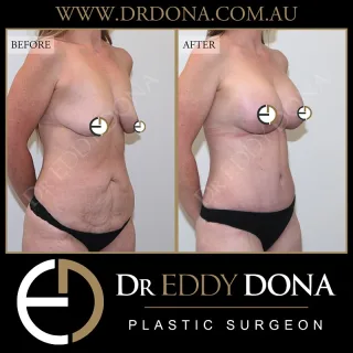 BIO Lift ™: Breast Implant Only Lift + Abdominoplasty  Experience & Excellence in Plastic Surgery is what you deserve.  #BreastAugmentation #DrEddyDona #PlasticSurgery #Abdominoplasty  All surgery carries risks. You can learn more by visiting our website - link can be found in our
bio.
Or go to http://www.drdonaplasticsurgery.com.au/surgery-risks/  DISCLAIMER: All surgeries on this page are performed by Dr Eddy Dona and are published with the written consent by the patients.
After images are generally taken between 3-6 months post-surgery.
All surgery requires recovery time.
The outcomes shown are only relevant for this patient and do not necessarily reflect the results other patients may experience, even if they have a similar body type or shape.
Results may vary due to many factors including an individual’s genetics and lifestyle.
The content on this page is general in nature and is not a substitute for a formal consultation.
Before proceeding, please seek medical advice from an appropriately qualified medical practitioner.
Dr Eddy Dona is a Specialist Plastic Surgeon
(Registration: MED0001177175)