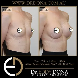 BREAST AUGMENTATION  Experience & Excellence in Plastic Surgery is what you deserve.  #BreastImplants #DrEddyDona #PlasticSurgery #BreastAugmentation  All surgery carries risks. You can learn more by visiting our website - link can be found in our
bio.
Or go to http://www.drdonaplasticsurgery.com.au/surgery-risks/  DISCLAIMER: All surgeries on this page are performed by Dr Eddy Dona and are published with the written consent by the patients.
After images are generally taken between 3-6 months post-surgery.
All surgery requires recovery time.
The outcomes shown are only relevant for this patient and do not necessarily reflect the results other patients may experience, even if they have a similar body type or shape.
Results may vary due to many factors including an individual’s genetics and lifestyle.
The content on this page is general in nature and is not a substitute for a formal consultation.
Before proceeding, please seek medical advice from an appropriately qualified medical practitioner.
Dr Eddy Dona is a Specialist Plastic Surgeon
(Registration: MED0001177175)