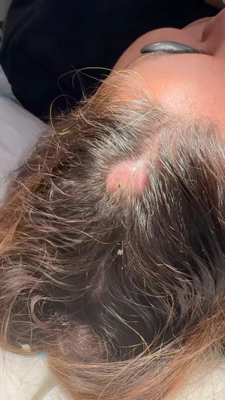 Laser Cyst Removal on Scalp.  All non-surgical treatments carry risks.
.
. 
DISCLAIMER: All non-surgical treatments on this page are performed by a Registered Nurse and are published with consent by the patient. Before & after images are generally shown immediately after treatment, unless otherwise stated. All non-surgical treatments carry risks and require some recovery time, and the results will vary for each individual patient. The content on this page is general in nature and is not a substitute for a formal consultation. 
To learn more, visit our website.  SL(NMW0002296267), Registered Nurse, (Division 1), General Registration