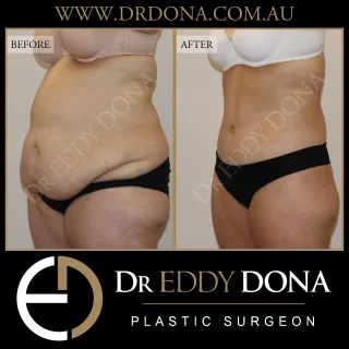 BELT LIPECTOMY  The Belt Lipectomy is an operation that goes by many different names:  - 360 Tummy Tuck (Abdominoplasty)
- Lower Body Lift 
- Total Body Lift
- Lower Truncoplasty 
- Buttock Lift combined with a Tummy Tuck  This patient was reviewed 6 months post surgery. 
She had approximately 6kg of excess removed, her rectus muscles were repaired and pubic area lifted - total abdominal wall reconstruction.  Experience & Excellence in Plastic Surgery is what you deserve  #DrEddyDona  #PlasticSurgeon #BraLipectomy  #FleurDeLis #OpenBook  #TummyTuck#Abdominoplasty #BeltLipectomy  All surgery carries risks. You can learn more by visiting our website - link can be found in our bio. Or go to www.drdonaplasticsurgery.com.au/surgery-risks/ 
DISCLAIMER: All surgeries on this page are performed by Dr Eddy Dona and are published with the written consent by the patients.
After images are generally taken between 3-6 months post-surgery.
All surgery requires recovery time.
The outcomes shown are only relevant for this patient and do not necessarily reflect the results other patients may experience, even if they have a similar body type or shape. Results may vary due to many factors including an individual’s genetics and lifestyle.
The content on this page is general in nature and is not a substitute for a formal consultation. Before proceeding, please seek medical advice from an appropriately qualified medical practitioner. Dr Eddy Dona is a Specialist Plastic Surgeon (Registration: MED0001177175)