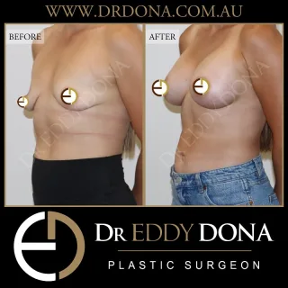 BIO-Lift™ - Breast Implant Only Lift  This patient underwent Dr Dona’s custom BIO-Lift™ procedure. In the right patient, a breast implant only can avoid the extensive scars associated with traditional breast lift procedures.  Dr Dona’s key elements to this surgery include:
- The use of specific implant shapes and dimensions designed to ‘wedge and elevate’ the breast tissue and nipple position
- A strategic approach to breast implant placement
- Customised internal breast tissue manipulation  Experience & Excellence in Plastic Surgery is what you deserve.  #BreastImplants #DrEddyDona #PlasticSurgery #BreastAugmentation  All surgery carries risks. You can learn more by visiting our website - link can be found in our
bio.Or go to 
http://www.drdonaplasticsurgery.com.au/surgery-risks/  DISCLAIMER: All surgeries on this page are performed by Dr Eddy Dona and are published with the written consent by the patients.
After images are generally taken between 3-6 months post-surgery.
All surgery requires recovery time.
The outcomes shown are only relevant for this patient and do not necessarily reflect the results other patients may experience, even if they have a similar body type or shape.
Results may vary due to many factors including an individual’s genetics and lifestyle.
The content on this page is general in nature and is not a substitute for a formal consultation.
Before proceeding, please seek medical advice from an appropriately qualified medical practitioner.
Dr Eddy Dona is a Specialist Plastic Surgeon
(Registration: MED0001177175)