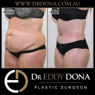 BELT LIPECTOMY  The Belt Lipectomy is an operation that goes by many different names:  - 360 Tummy Tuck (Abdominoplasty)
- Lower Body Lift 
- Total Body Lift
- Lower Truncoplasty 
- Buttock Lift combined with a Tummy Tuck  This patient was reviewed 6 months post surgery. 
She had approximately 6kg of excess removed, her rectus muscles were repaired and pubic area lifted - total abdominal wall reconstruction.  Experience & Excellence in Plastic Surgery is what you deserve  #DrEddyDona  #PlasticSurgeon #BraLipectomy  #FleurDeLis #OpenBook  #TummyTuck#Abdominoplasty #BeltLipectomy  All surgery carries risks. You can learn more by visiting our website - link can be found in our bio. Or go to www.drdonaplasticsurgery.com.au/surgery-risks/ 
DISCLAIMER: All surgeries on this page are performed by Dr Eddy Dona and are published with the written consent by the patients.
After images are generally taken between 3-6 months post-surgery.
All surgery requires recovery time.
The outcomes shown are only relevant for this patient and do not necessarily reflect the results other patients may experience, even if they have a similar body type or shape. Results may vary due to many factors including an individual’s genetics and lifestyle.
The content on this page is general in nature and is not a substitute for a formal consultation. Before proceeding, please seek medical advice from an appropriately qualified medical practitioner. Dr Eddy Dona is a Specialist Plastic Surgeon (Registration: MED0001177175)
