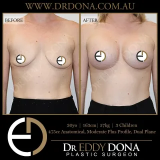 BIO-Lift™ - Breast Implant Only Lift  This patient underwent Dr Dona’s custom BIO-Lift™ procedure. In the right patient, a breast implant only can avoid the extensive scars associated with traditional breast lift procedures.  Dr Dona’s key elements to this surgery include:
- The use of specific implant shapes and dimensions designed to ‘wedge and elevate’ the breast tissue and nipple position
- A strategic approach to breast implant placement
- Customised internal breast tissue manipulation  Experience & Excellence in Plastic Surgery is what you deserve.  #BreastImplants #DrEddyDona #PlasticSurgery #BreastAugmentation  All surgery carries risks. You can learn more by visiting our website - link can be found in our
bio.Or go to 
http://www.drdonaplasticsurgery.com.au/surgery-risks/  DISCLAIMER: All surgeries on this page are performed by Dr Eddy Dona and are published with the written consent by the patients.
After images are generally taken between 3-6 months post-surgery.
All surgery requires recovery time.
The outcomes shown are only relevant for this patient and do not necessarily reflect the results other patients may experience, even if they have a similar body type or shape.
Results may vary due to many factors including an individual’s genetics and lifestyle.
The content on this page is general in nature and is not a substitute for a formal consultation.
Before proceeding, please seek medical advice from an appropriately qualified medical practitioner.
Dr Eddy Dona is a Specialist Plastic Surgeon
(Registration: MED0001177175)