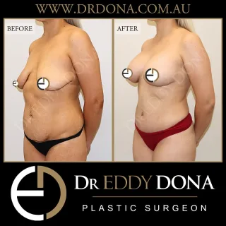 BIO Lift ™: Breast Implant Only Lift + Abdominoplasty  Experience & Excellence in Plastic Surgery is what you deserve.  #BreastAugmentation #DrEddyDona #PlasticSurgery #Abdominoplasty  All surgery carries risks. You can learn more by visiting our website - link can be found in our
bio.
Or go to http://www.drdonaplasticsurgery.com.au/surgery-risks/  DISCLAIMER: All surgeries on this page are performed by Dr Eddy Dona and are published with the written consent by the patients.
After images are generally taken between 3-6 months post-surgery.
All surgery requires recovery time.
The outcomes shown are only relevant for this patient and do not necessarily reflect the results other patients may experience, even if they have a similar body type or shape.
Results may vary due to many factors including an individual’s genetics and lifestyle.
The content on this page is general in nature and is not a substitute for a formal consultation.
Before proceeding, please seek medical advice from an appropriately qualified medical practitioner.
Dr Eddy Dona is a Specialist Plastic Surgeon
(Registration: MED0001177175)