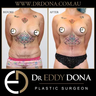 REVISION FLEUR DE LIS TUMMY TUCK (Abdominoplasty) & Breast Implant Revision  Dr Dona discusses and demonstrates a revision case (original surgery performed elsewhere) which required a Fleur De Lis Tummy Tuck.
This patient also wanted a much fuller breast enhancement and tighter cleavage. Her original breast implant surgery was also performed elsewhere. Dr Dona removed her old implants, made significant internal modifications to her breast implant pockets, and provided her desired look with 825cc extra high profile round implants.  Experience & Excellence in Plastic Surgery is what you deserve  #DrEddyDona  #PlasticSurgeon #FleurDeLis #OpenBook  #TummyTuck #Abdominoplasty  All surgery carries risks. You can learn more by visiting our website - link can be found in our bio. Or go to www.drdonaplasticsurgery.com.au/surgery-risks/ 
DISCLAIMER: All surgeries on this page are performed by Dr Eddy Dona and are published with the written consent by the patients.
After images are generally taken between 3-6 months post-surgery.
All surgery requires recovery time.
The outcomes shown are only relevant for this patient and do not necessarily reflect the results other patients may experience, even if they have a similar body type or shape. Results may vary due to many factors including an individual’s genetics and lifestyle.
The content on this page is general in nature and is not a substitute for a formal consultation. Before proceeding, please seek medical advice from an appropriately qualified medical practitioner. Dr Eddy Dona is a Specialist Plastic Surgeon (Registration: MED0001177175)