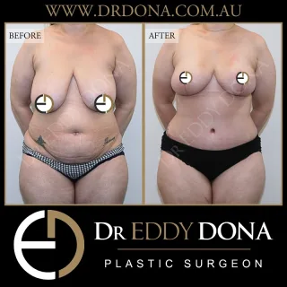 Breast Reduction + Abdominoplasty 

Experience & Excellence in Plastic Surgery is what you deserve.

#BreastReduction #DrEddyDona #PlasticSurgery #Abdominoplasty 

All surgery carries risks. You can learn more by visiting our website - link can be found in our
bio.
Or go to http://www.drdonaplasticsurgery.com.au/surgery-risks/

DISCLAIMER: All surgeries on this page are performed by Dr Eddy Dona and are published with the written consent by the patients.
After images are generally taken between 3-6 months post-surgery.
All surgery requires recovery time.
The outcomes shown are only relevant for this patient and do not necessarily reflect the results other patients may experience, even if they have a similar body type or shape.
Results may vary due to many factors including an individual’s genetics and lifestyle.
The content on this page is general in nature and is not a substitute for a formal consultation.
Before proceeding, please seek medical advice from an appropriately qualified medical practitioner.
Dr Eddy Dona is a Specialist Plastic Surgeon
(Registration: MED0001177175)